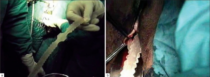A Comparative Evaluation of Suburethral and Transobturator Sling in 209 Cases with Stress Urinary Incontinence in 8 years.