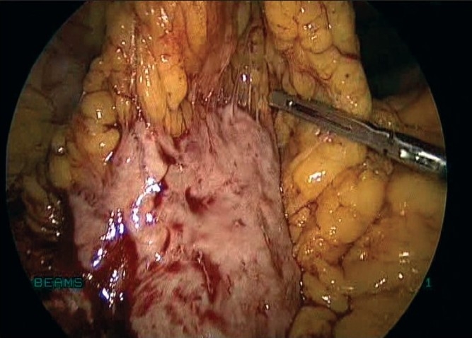 Parasitic myoma after morcellation.