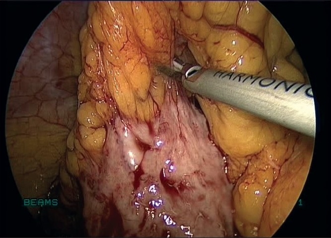 Parasitic myoma after morcellation.