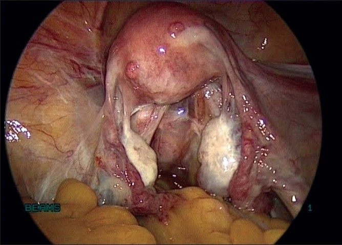 Parasitic myoma after morcellation.