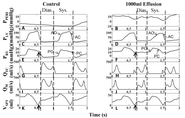 Using a human cardiovascular-respiratory model to characterize cardiac tamponade and pulsus paradoxus.