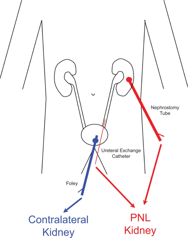 Differences in quantitative urine composition in stone-forming versus unaffected mate kidneys.