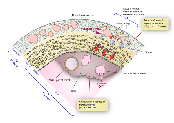 Controlling the angiogenic switch in developing atherosclerotic plaques: possible targets for therapeutic intervention.