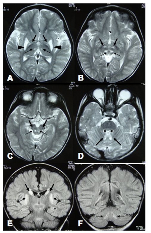 Leigh syndrome: MRI findings in two children.