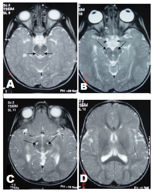 Leigh syndrome: MRI findings in two children.