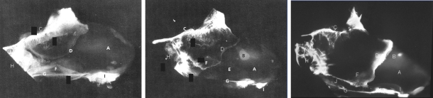 Rhinosurgery in children: developmental and surgical aspects of the growing nose.