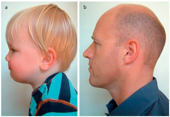 Rhinosurgery in children: developmental and surgical aspects of the growing nose.