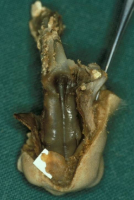 Rhinosurgery in children: developmental and surgical aspects of the growing nose.