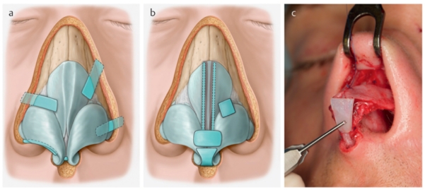 Structural grafts and suture techniques in functional and aesthetic rhinoplasty.