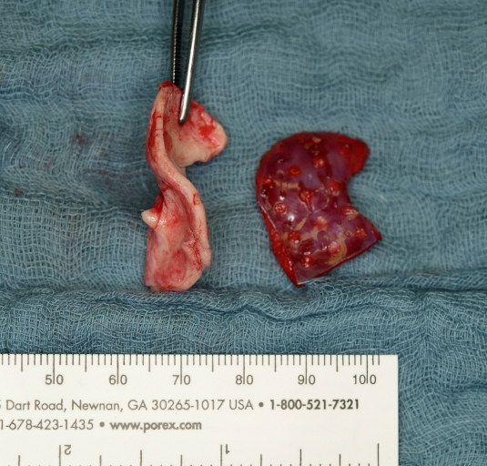 Structural grafts and suture techniques in functional and aesthetic rhinoplasty.
