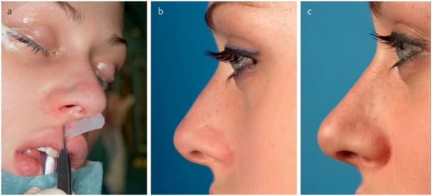Structural grafts and suture techniques in functional and aesthetic rhinoplasty.