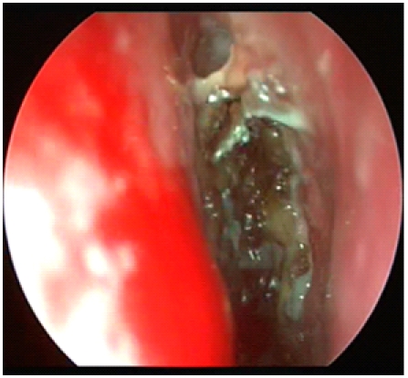 Nasal surgery in patients with systemic disorders.