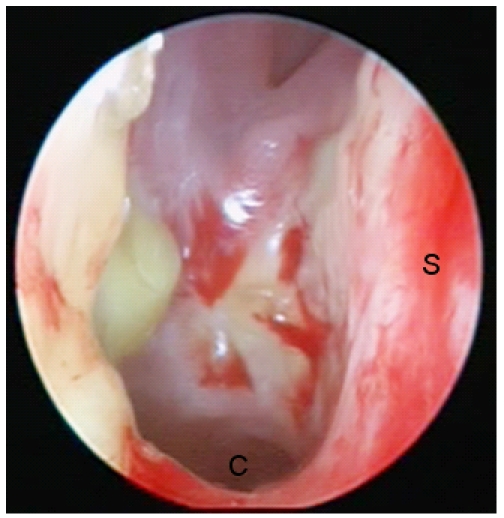 Nasal surgery in patients with systemic disorders.