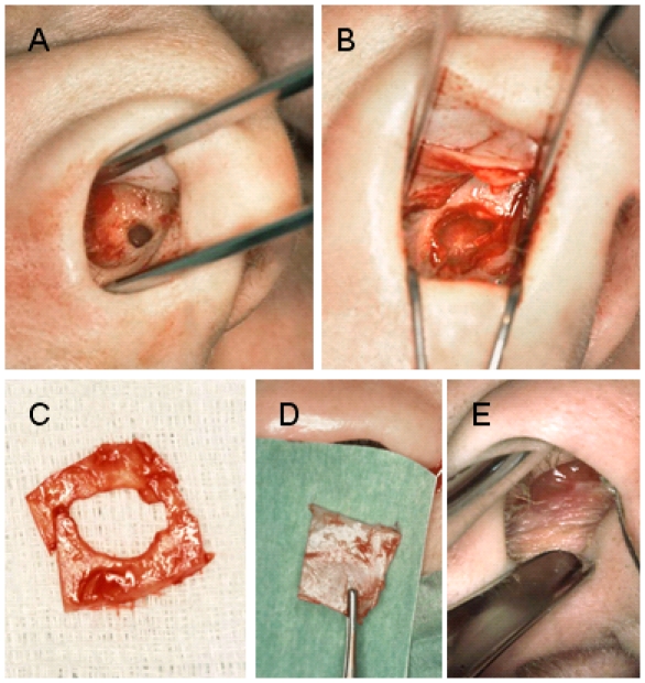 Nasal surgery in patients with systemic disorders.