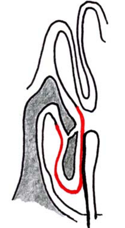 Surgery of the turbinates and "empty nose" syndrome.