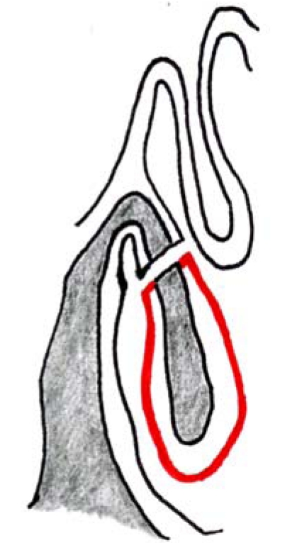 Surgery of the turbinates and "empty nose" syndrome.
