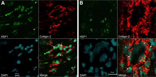 Overexpression of Colligin 2 in Glioma Vasculature is Associated with Overexpression of Heat Shock Factor 2.