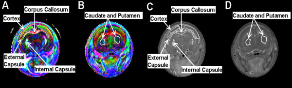 Diffusion tensor imaging correlates with cytopathology in a rat model of neonatal hydrocephalus.