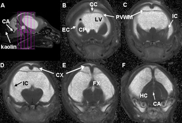 Diffusion tensor imaging correlates with cytopathology in a rat model of neonatal hydrocephalus.