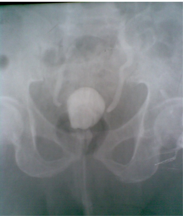 Post open prostatectomy bladder exteriorization mimicking "acquired bladder extrophy".