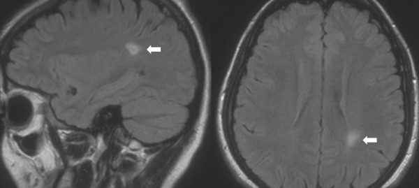 Incidental findings on MRI scans of patients presenting with audiovestibular symptoms.