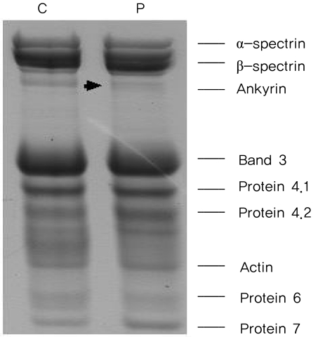 A case of concomitant Gilbert's syndrome and hereditary spherocytosis.