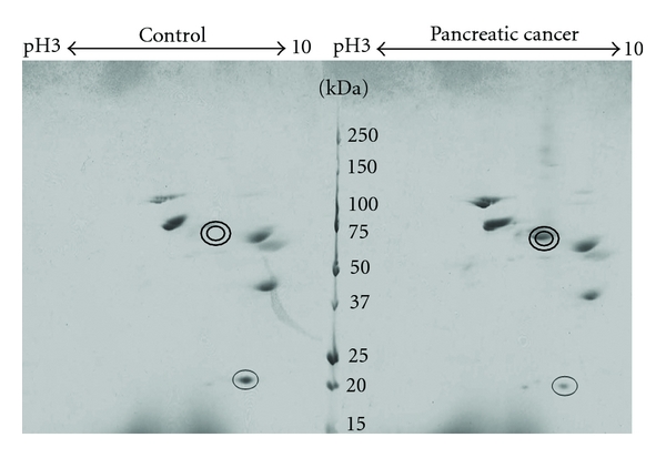 The application of a three-step proteome analysis for identification of new biomarkers of pancreatic cancer.