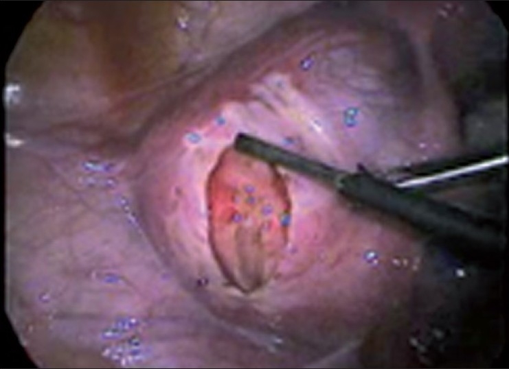 Laparoscopic management of broad ligament fibroids.