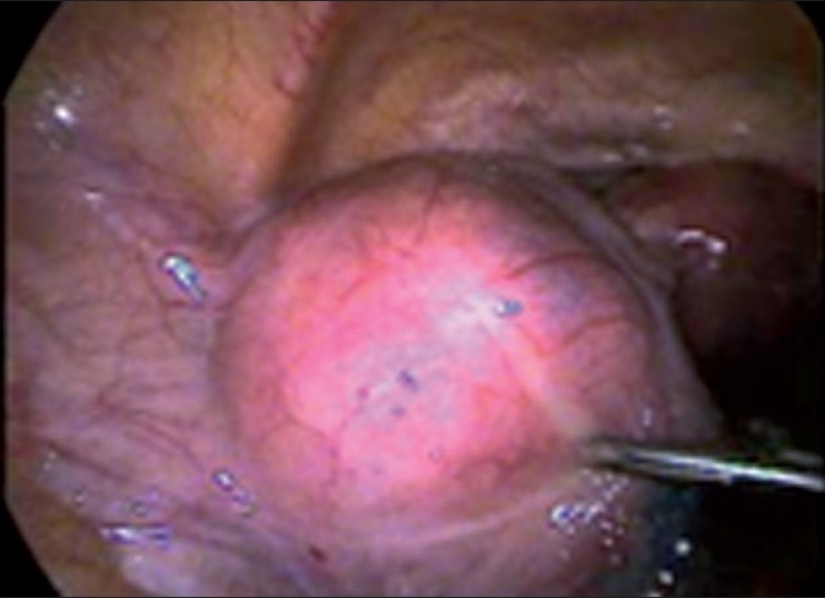Laparoscopic management of broad ligament fibroids.