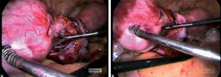 Laparoscopic management of broad ligament fibroids.