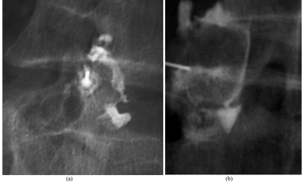 Image-guided facet joint injection.