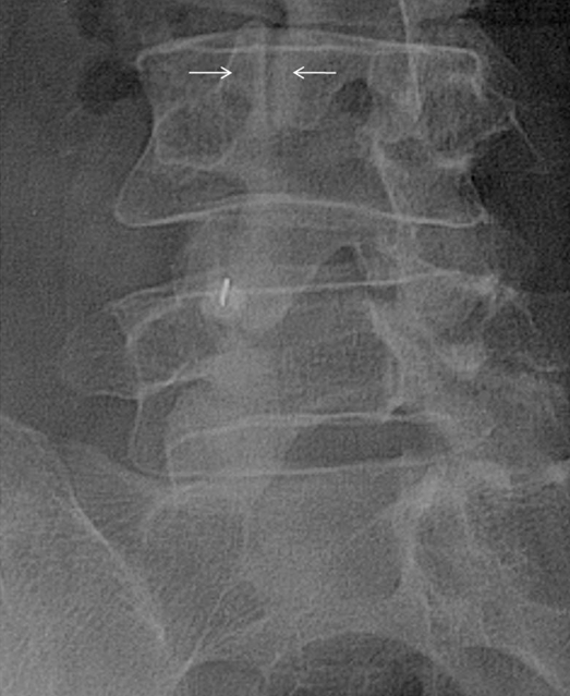 Image-guided facet joint injection.