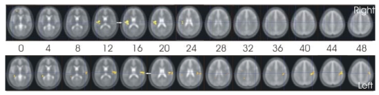 Caudate nucleus and insular activation during a pain suppression paradigm comparing thermal and electrical stimulation.