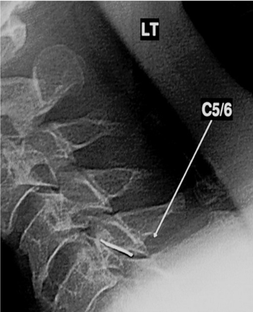 Image-guided facet joint injection.