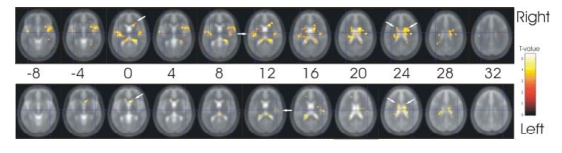 Caudate nucleus and insular activation during a pain suppression paradigm comparing thermal and electrical stimulation.