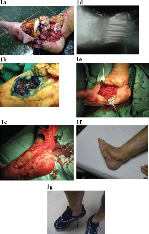 The use of Papineau technique for the treatment of diabetic and non-diabetic lower extremity pseudoarthrosis and chronic osteomyelitis.