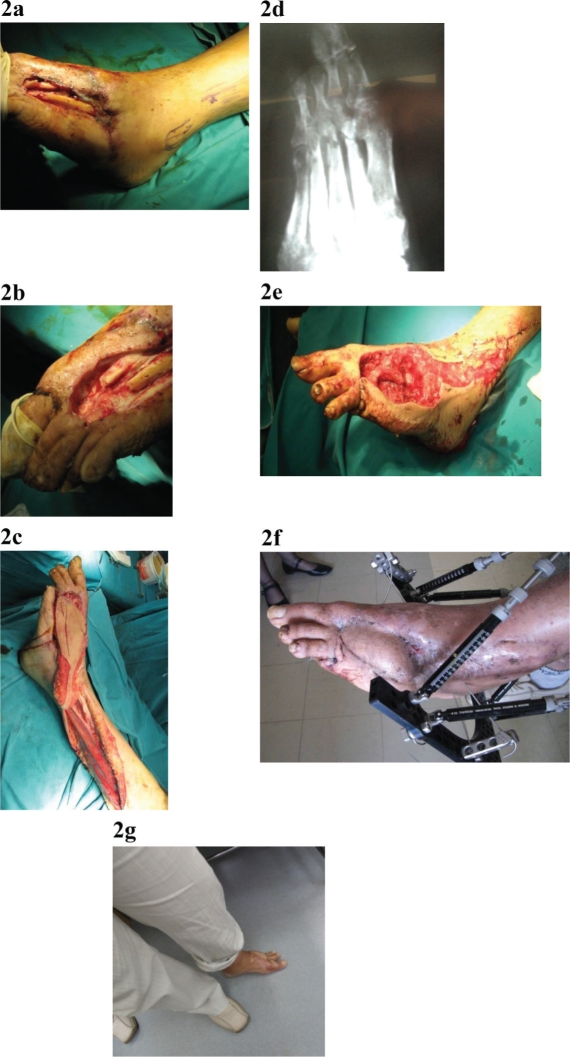 The use of Papineau technique for the treatment of diabetic and non-diabetic lower extremity pseudoarthrosis and chronic osteomyelitis.