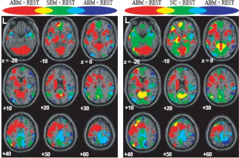 Brain activation during autobiographical memory retrieval with special reference to default mode network.