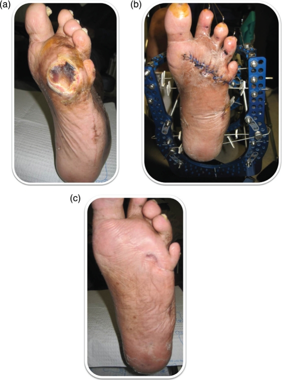 Recurrence of diabetic pedal ulcerations following tendo-achilles lengthening.