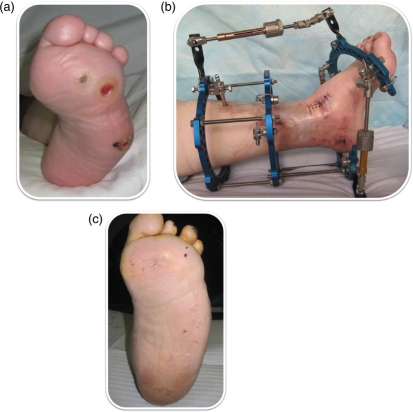 Recurrence of diabetic pedal ulcerations following tendo-achilles lengthening.