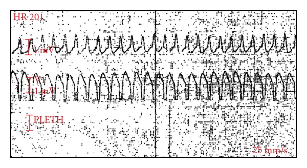 An Uncommon Ventricular Tachycardia due to Inactive PPM Lead.