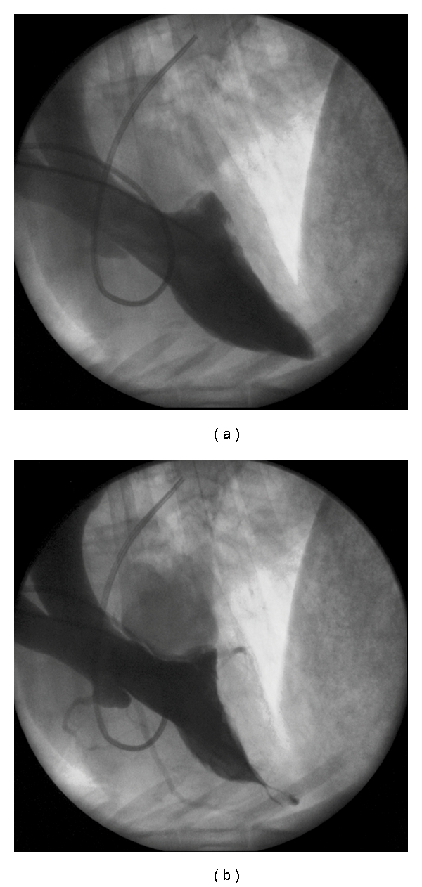 Modification of a volume-overload heart failure model to track myocardial remodeling and device-related reverse remodeling.