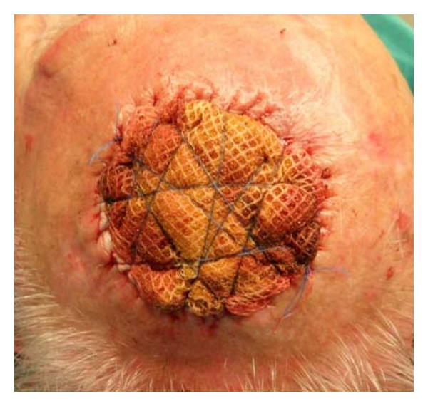 Use of surgical sponge with running sutures for securing full-thickness skin grafts.