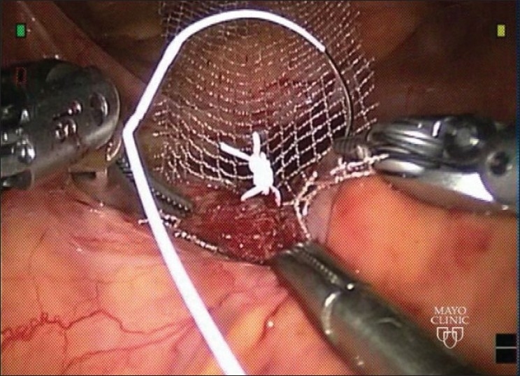 Robotic sacrocolpopexy: an observational experience at mayoclinic, USA.