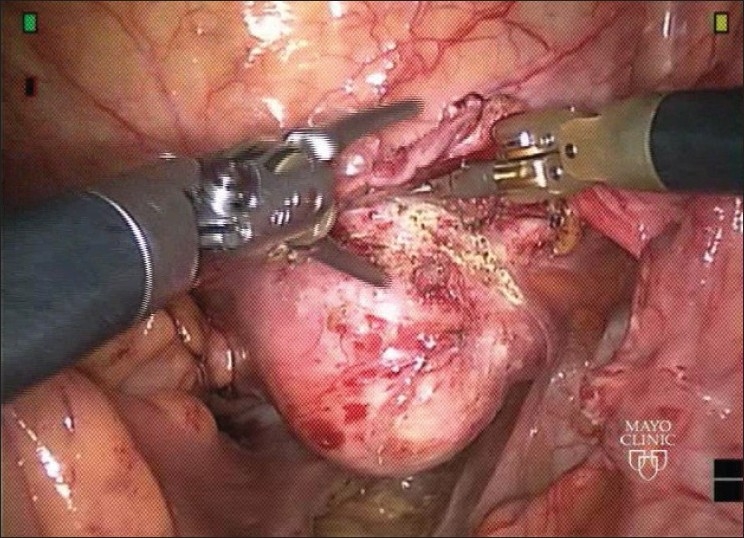 Robotic sacrocolpopexy: an observational experience at mayoclinic, USA.