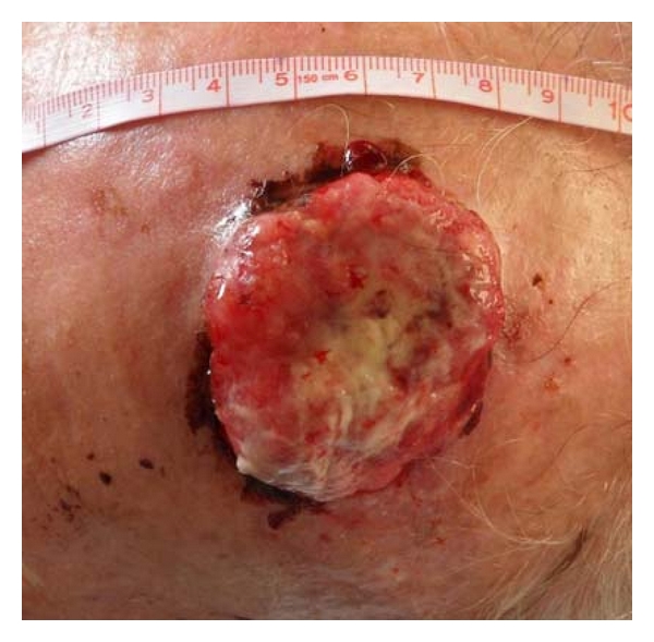 Use of surgical sponge with running sutures for securing full-thickness skin grafts.