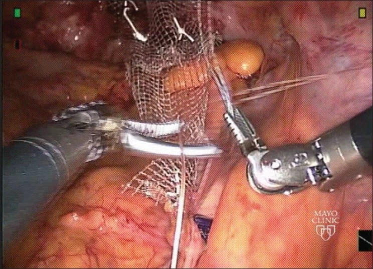 Robotic sacrocolpopexy: an observational experience at mayoclinic, USA.