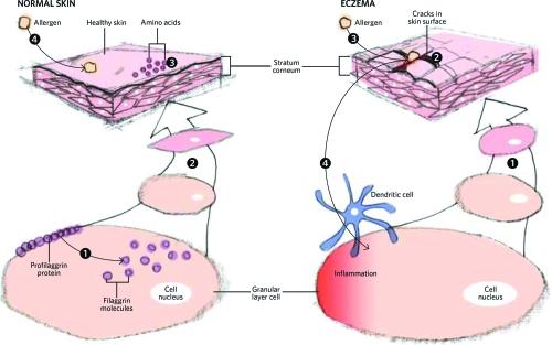 The allergy gene: how a mutation in a skin protein revealed a link between eczema and asthma.