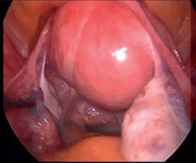 Single incision laparoscopic myomectomy.
