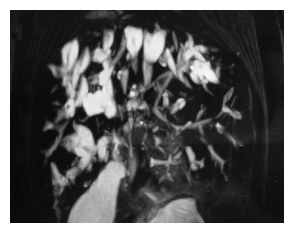 Living Donor Liver Transplantation for Caroli's Disease: A Report of Two Cases.